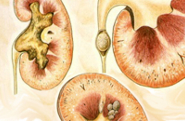 Удаление камней из мочевого пузыря • Русский Доктор