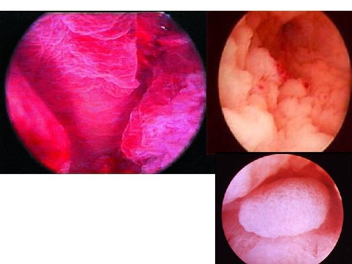 На кольпоскопии