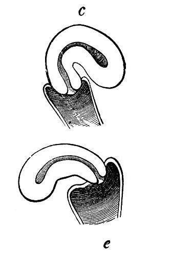 Правосторонняя и левосторонняя летерофлексия