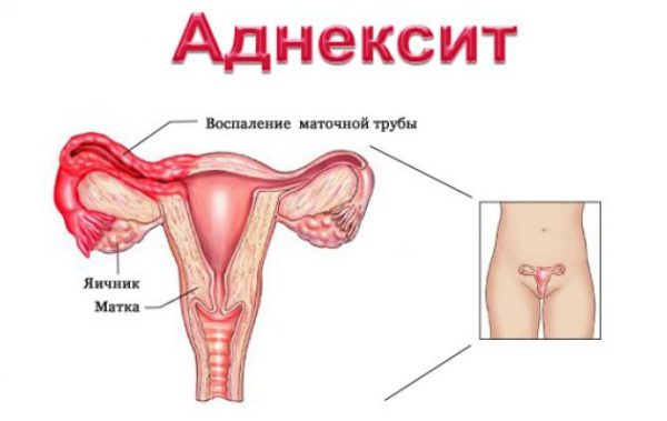 Аднексит