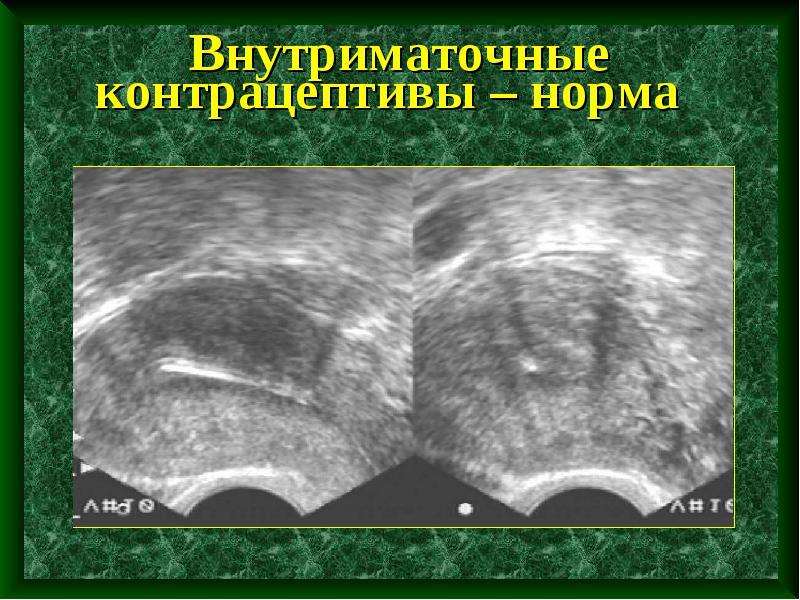 Контрацептивы