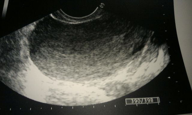 Вне беременности