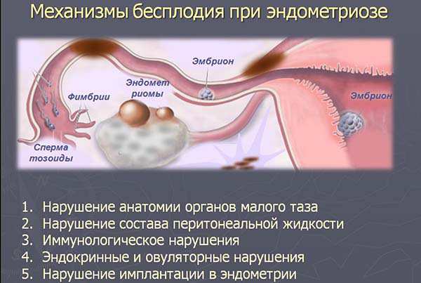 Эндометриоз