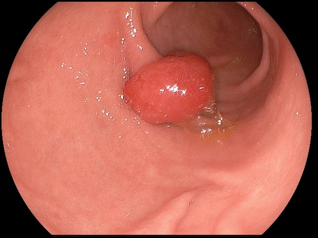 Полип эндометрия