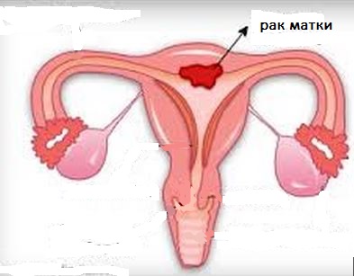 Рак матки