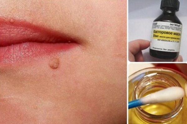 Папилломы на лице и касторовое масло Касторовое масло от папиллом