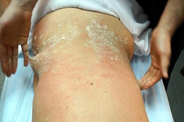 Как втирать мед при массаже Техника медового массажа