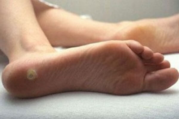 Пяточная шпора - фото Шпоры на пятках