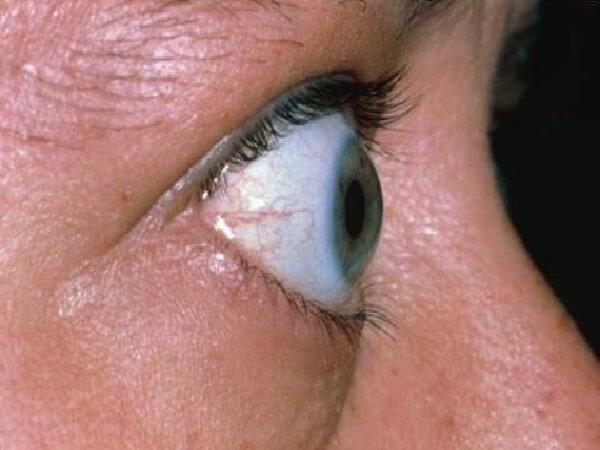 Тиреотоксикоз Лечение тиреотоксикоза Эндонорм