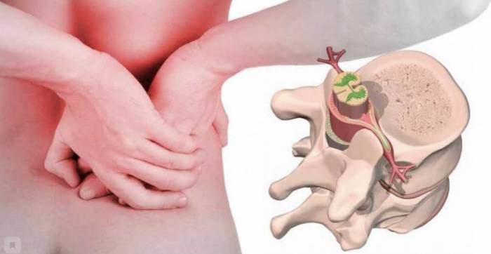 Реабилитация после удаления позвоночной грыжи - Реабилитация после удаления позвоночной грыжи