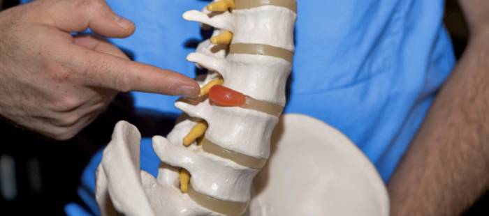 Симптомы грыжи диска позвоночника - Симптомы грыжи диска позвоночника