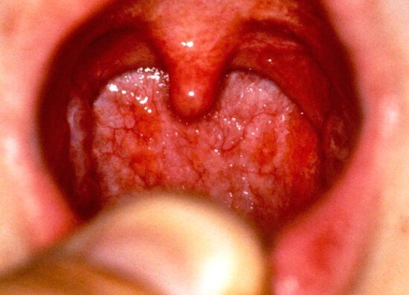 virusnaya-angina.jpg virusnaya-angina.jpg