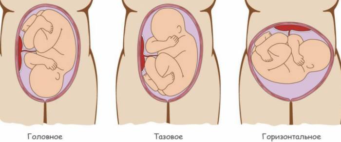 Лечение низкого предлежания плаценты Лечение низкого предлежания плаценты -
