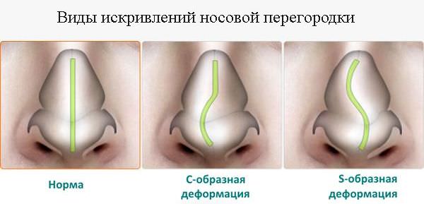 Виды искривлений