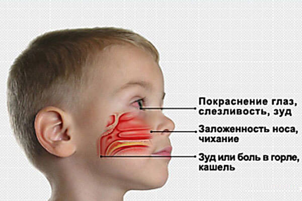 Заложенность носа, красные глаза Симптомы, указывающие на развитие аллергического ринита