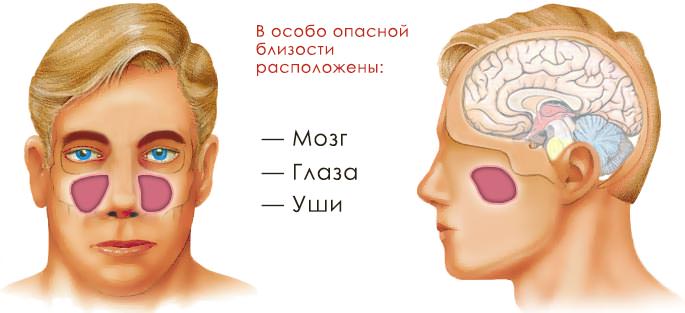 Чем опасен гайморит