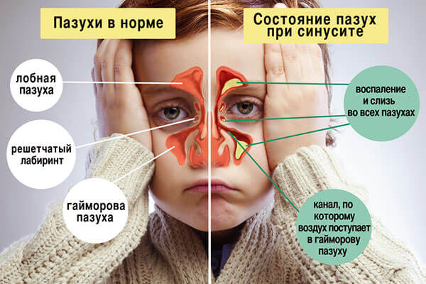 Чистые пазухи носа и заполненные слизью Нормальное состояние пазух и при развитии гайморита