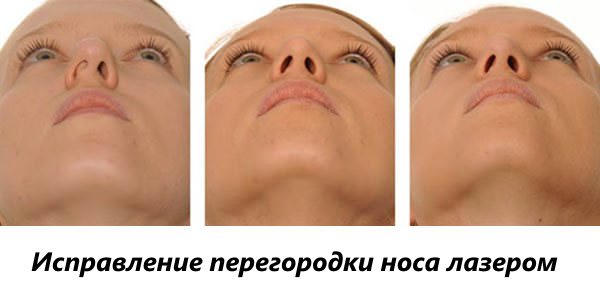 Нос девушки до и после лечения Исправление носовой перегородки лазером