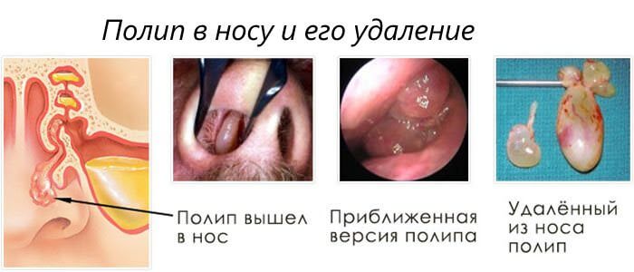 Как выглядят полипы Операция по удалению полипов