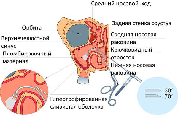 Удаление кисты Операция по удалению кисты в носу