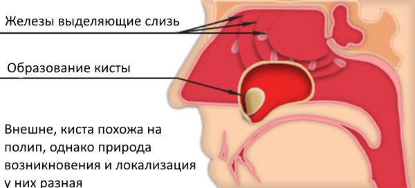 Киста в носу Образование кисты в носовой пазухе