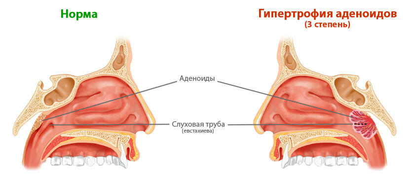Аденоидные вегетации