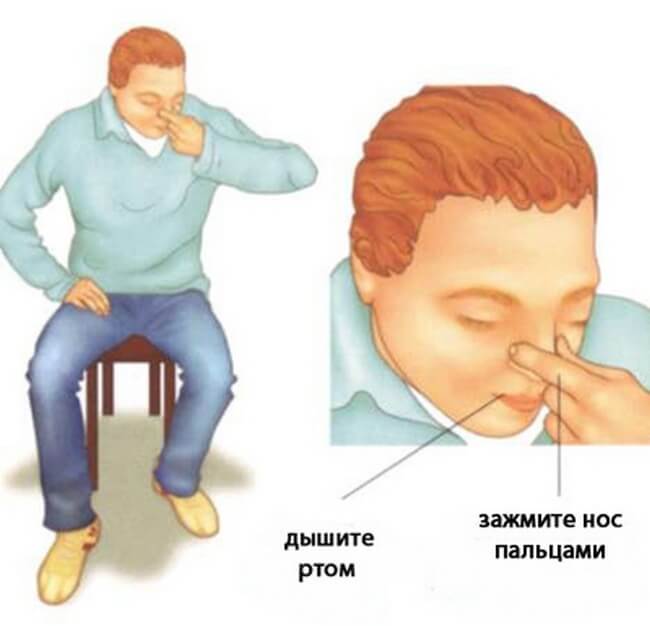 Остановка кровотечения
