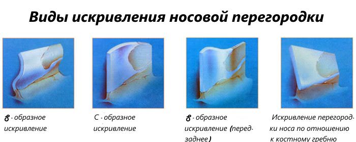 Разное искривление перегородки носа Виды искривления носовой перегородки
