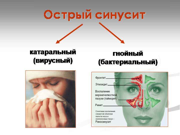 Острый синусит