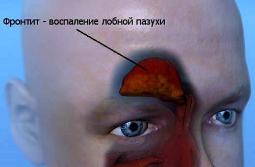 Фронтит