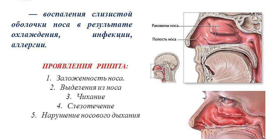 Ринит