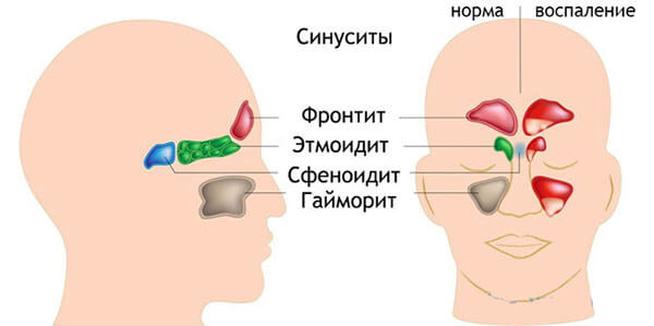 Болезни носовых пазух Типы воспалительных реакций в носовых пазухах