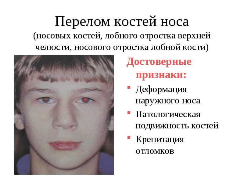Признаки перелома