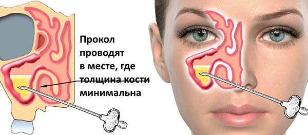Правильное введение иглы Прокол проводят под местным наркозом
