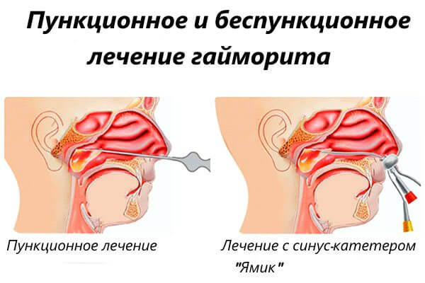 Разные методы лечения Способы лечения гайморита