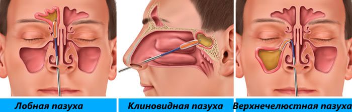 Собирающие гной пазухи Гайморовые пазухи, в которых делают прокол