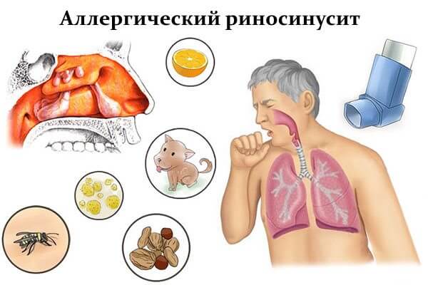 Источники аллергического риносинусита Аллергический риносинусит развивается при постоянном воздействии аллергенов
