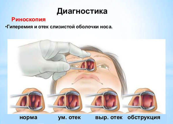 Диагностика заболевания Риноскопия носовых проходов