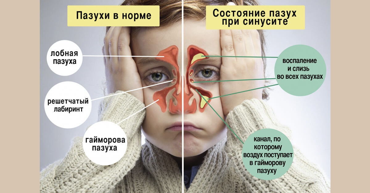 Верхнечелюстной синусит