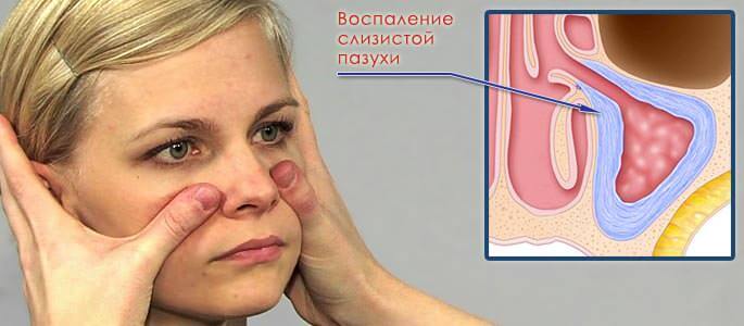 Воспаление слизистой пазухи