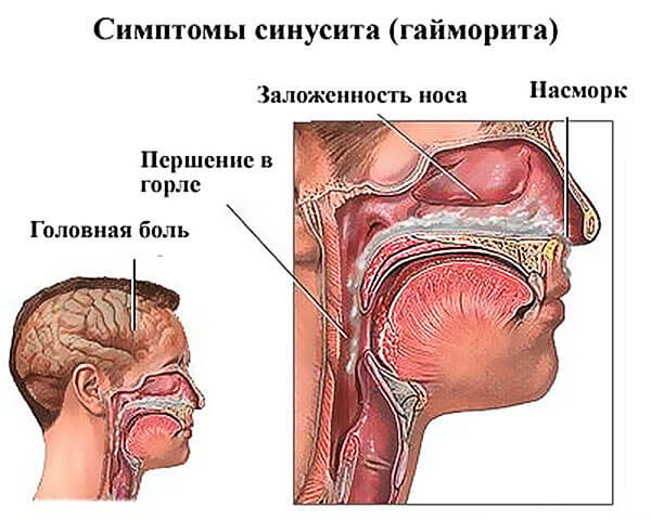 Гайморит и его симптомы Симптомы развития гайморита