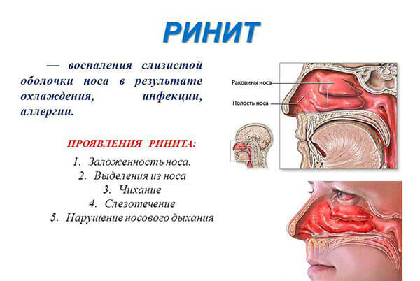 Признаки ринита Проявления ринита